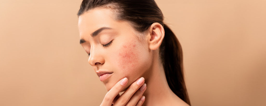 Rossori e pelle sensibile? Ascolta la tua pelle!