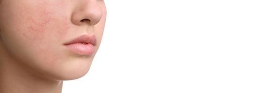 Pelle sensibile: un problema a volte invisibile